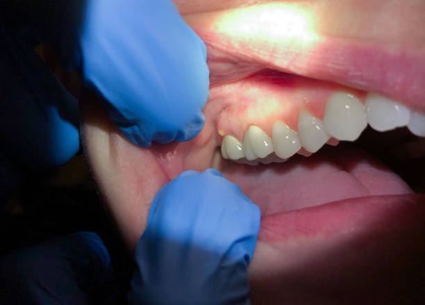 Best Emergency Treatment for Oral Infections in Somerville, NJ